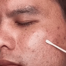 Anti-Blackhead Green Tea Miracle Stick - Removes Blackheads from Face and Nose