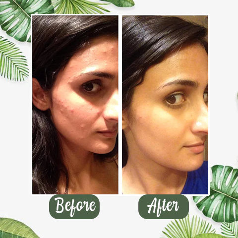 Anti-Blackhead Green Tea Miracle Stick - Removes Blackheads from Face and Nose