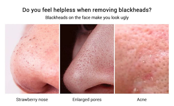 LANBENA Anti - Blackhead Peel Off Mask - Removes Blackheads from Face and Nose - Sccoti