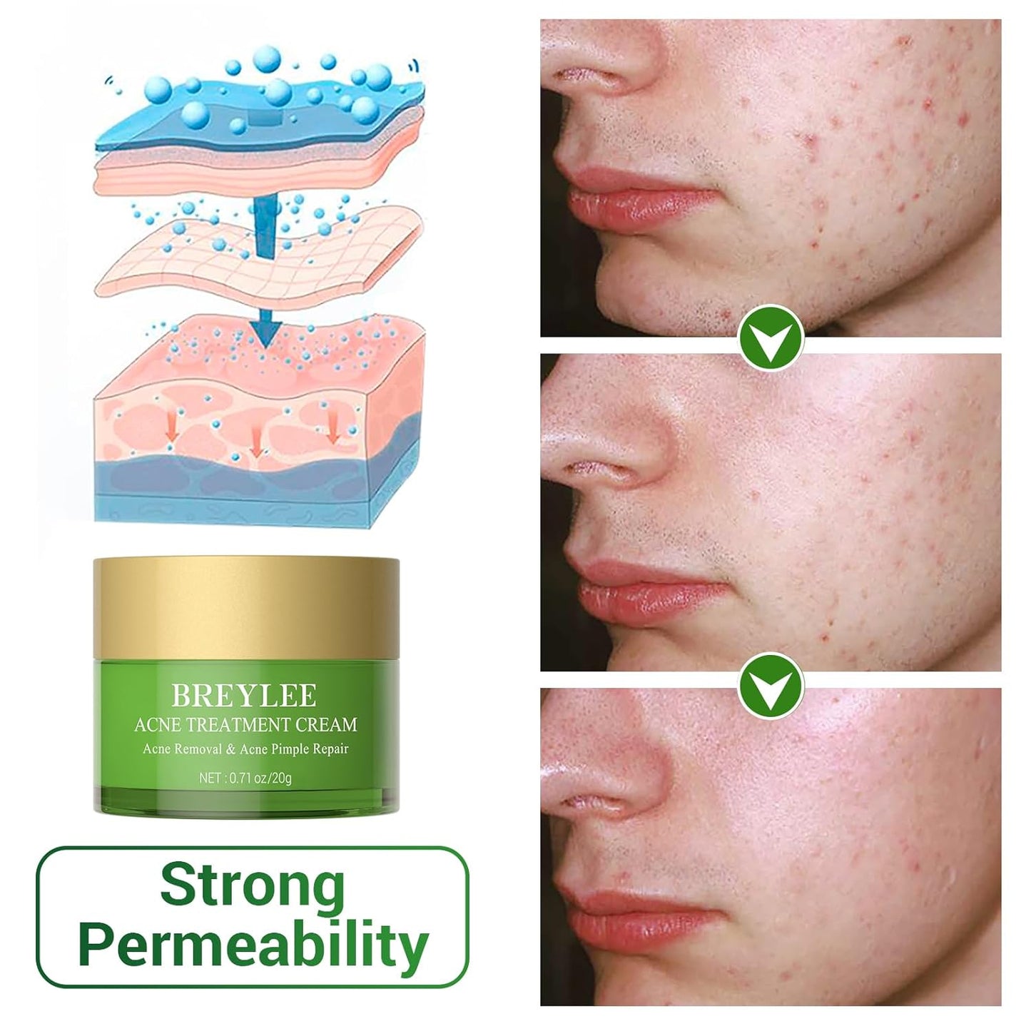 BREYLEE Acne Treatment Cream, Tea Tree Oil Acne Cream for Clearing Severe Acne, Breakout, Remove Pimple and Repair Skin (20ml,0.7oz)