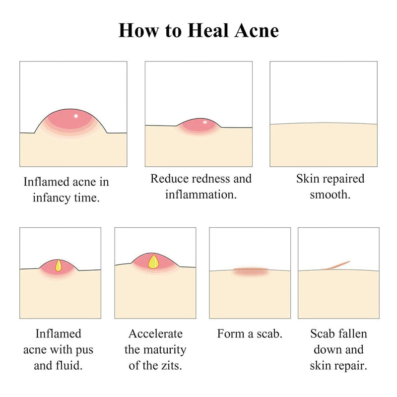 BREYLEE Acne Treatment Cream, Tea Tree Oil Acne Cream for Clearing Severe Acne, Breakout, Remove Pimple and Repair Skin (20ml,0.7oz) - Sccoti