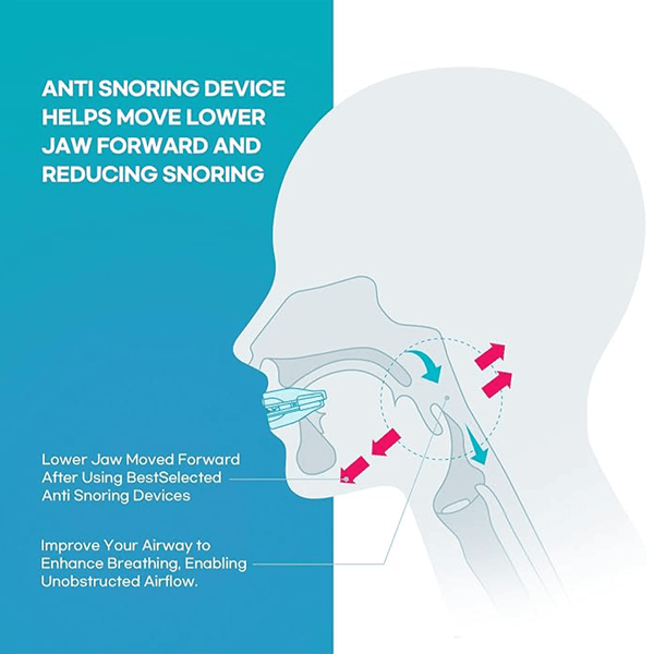 Flexible and adaptable anti - snoring and sleep apnea orthosis - Sccoti