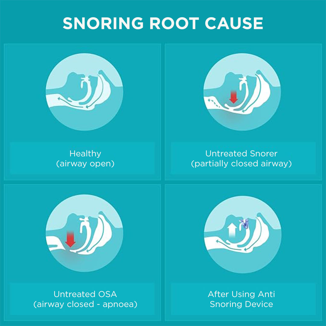 Flexible and adaptable anti-snoring and sleep apnea orthosis