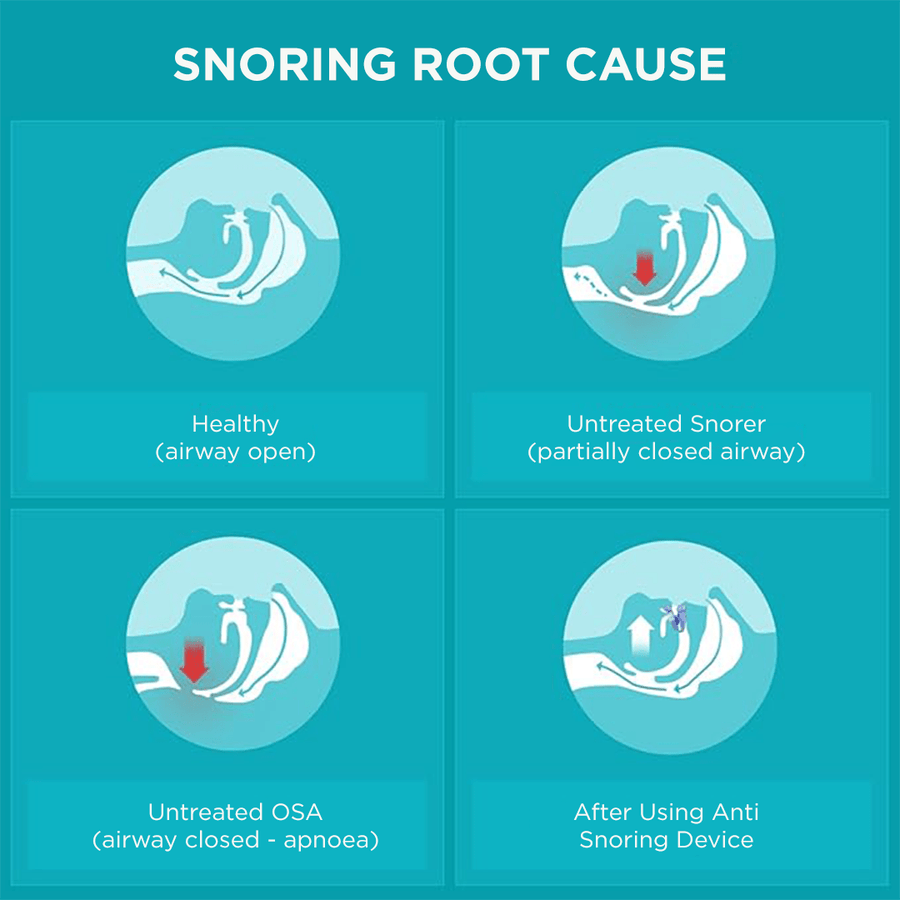 Flexible and adaptable anti - snoring and sleep apnea orthosis - Sccoti