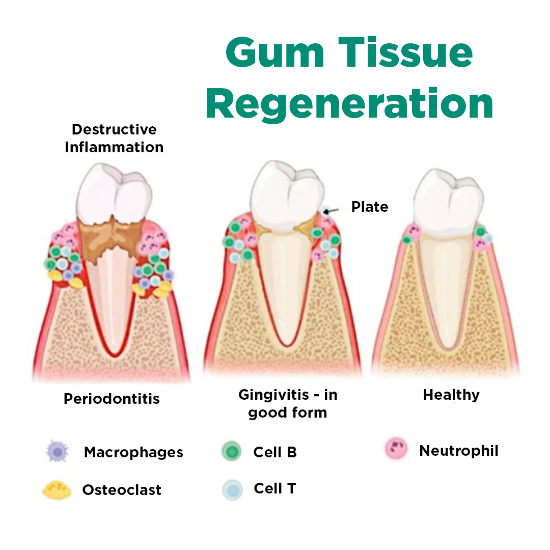 JaySuing™ Therapeutic Gel for Gum Relief